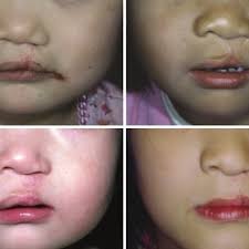 unilateral cleft lip cleft palate