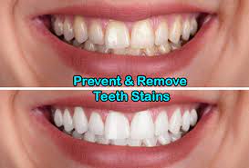 The teeth whitening process uses active ingredients to temporarily open pores in your teeth and lift stains. Prevent Remove Teeth Stains Regent Dental Cambridge
