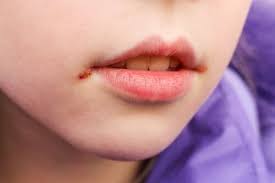 mouth sores in children causes and