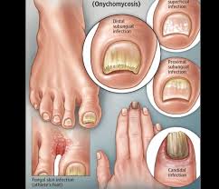 fungal nail infection fungus