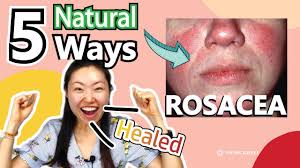 10 home remes for rosacea that