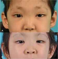 cleft palate in kabuki syndrome