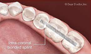 Please seek your oral health professional for care. Splinting Treatment For Loose Teeth