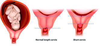 short cervix during pregnancy short