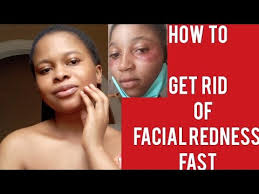 how to get rid of redness fast