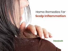 scalp inflammation home remes these