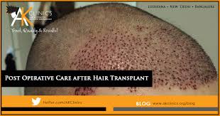 Maybe you would like to learn more about one of these? Hair Transplant Post Op Instructions Post Op Care What To Expect Ak Clinics