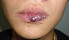 tongue and lip hemangioma in