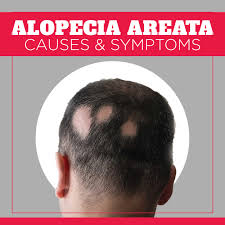 Alopecia is the partial or complete loss of hair—especially on the scalp—either in patches (alopecia alopecia areata affects both sexes and all ages but is most common in children five to 12 years old. Alopecia Areata Causes Symptoms Irestore Laser Hair Growth System India