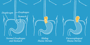 paraesophageal hernia gerd in houston