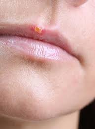 what are the ses of a cold sore