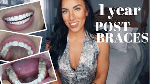 Sometimes they're used to help a one important way to take care of your retainer is not to lose it. 1 Year Post Braces Update Shifting Retainer Discomfort Wisdom Teeth Youtube