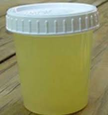 Image result for urine turbidity
