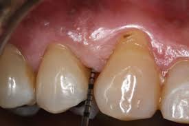 Where bone loss has occurred, they have the skills and knowledge to provide the treatment you bone grafting is a frequent component of periodontal surgical procedures. Stages Of Periodontal Disease Bayside Periodontics Dental Implants