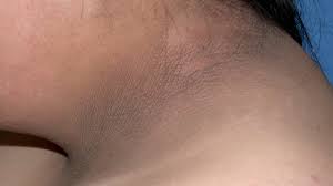 acanthosis nigricans treatment