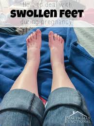 swollen feet during pregnancy