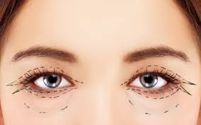 best upper eyelid surgery houston eye