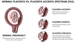 A placenta blocking the birth canal can result in hemorrhage and other scary outcomes. National Accreta Foundation What Is Placenta Accreta