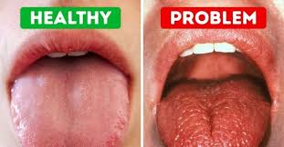 dry mouth xerostomia treatment