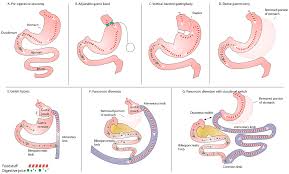 pancreatic exocrine insufficiency