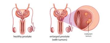 prostate cancer radiation oncology