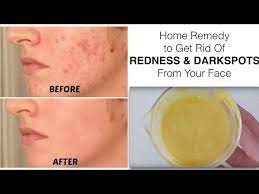 redness or red spots from your face