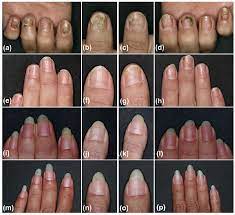 adalimumab for nail psoriasis