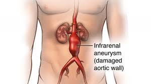 The blurring of vision, doubling, dilation of the pupil. How Serious Is An Aortic Aneurysm Aortic Aneurysm Symptoms And Cure