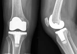 knee replacement central arizona