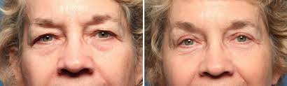 brow lift and eyelid surgery sarasota