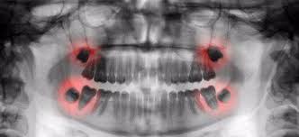 wisdom teeth can cause pericoronitis
