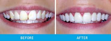 Can you straighten your teeth with. How To Get Straight Teeth Without Braces