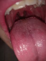 Außerdem treten pickel auf der zunge häufig auf, wenn die betroffene person unter verdauungsproblemen leidet. Was Sind Das Fur Pickel Hubel Auf Meiner Zunge Gesundheit Und Medizin Krankheit Zahne