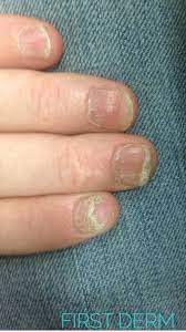 common nail discoloration