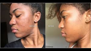 The trophy skin microderm md pays for itself after just a couple of uses. My 1st Microdermabrasion Treatment With Before And After Pics Renacer Spa Curacao Youtube