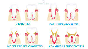 ses of periodontal disease how gum