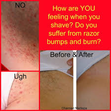 laser hair removal charmed spa