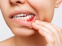 what causes dental cysts on gums