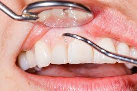 heal after tooth extraction