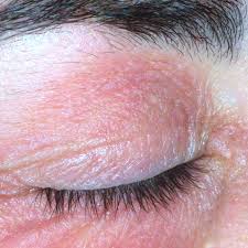 eyelid dermais most skincare