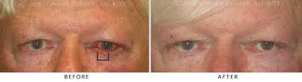 eyelid skin cancer excision before and