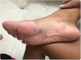 Gummata, which are large sores inside the body or on the skin. Syphilis Symptoms