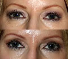 eyelid surgery blepharoplasty