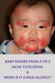 milk allergy baby rash