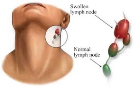 herbal remes for swollen lymph nodes