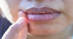 tips to get rid of white spots on lips