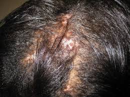 lymphocytic alopecia hair loss