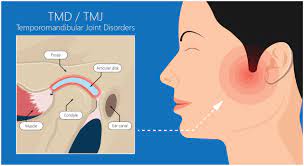 TMJ Treatment Fort Worth TX | Treating Jaw Pain Arlington TX
