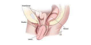 best uterine prolapse treatment