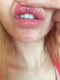 my lip after juvederm injections
